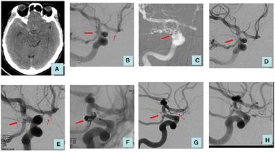 Endovascular treatment of multiple intracranial aneurysms in patients with subarachnoid hemorrhage: one or multiple sessions?